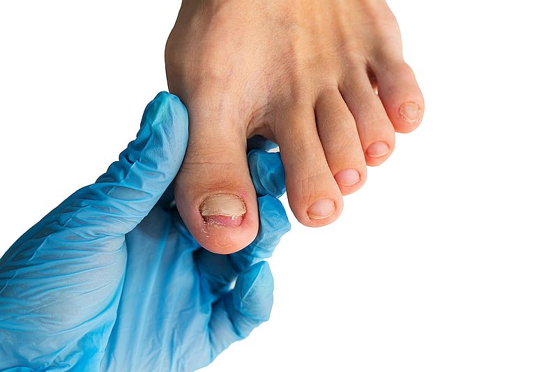 Nagel-Prothetik - bei kaputten oder deformierten Nägeln