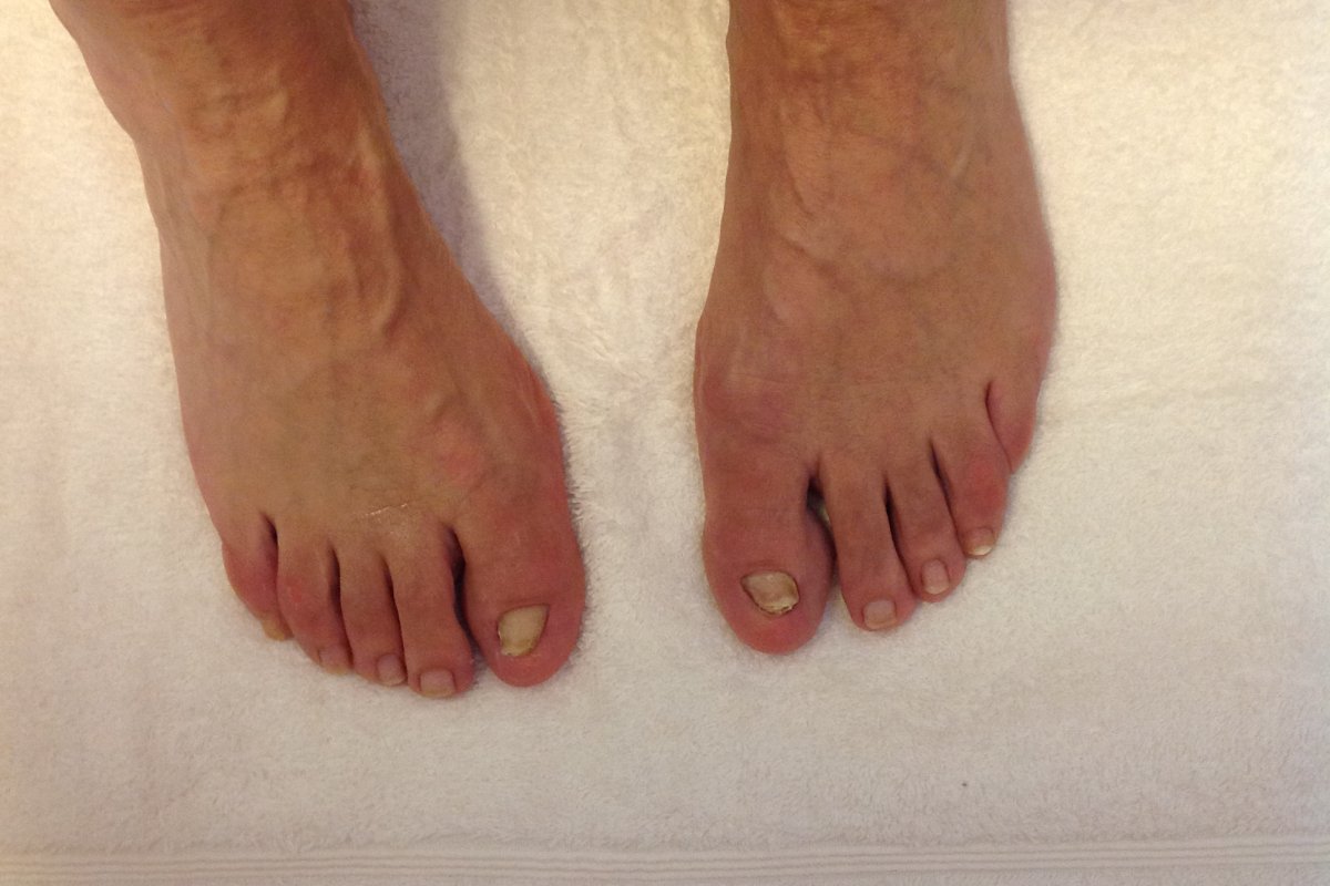 Vorher: Die Fußnägel der großen Zehen dieser Kundin sind beidseitig leider deformiert